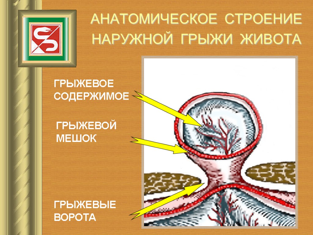 АНАТОМИЧЕСКОЕ СТРОЕНИЕ НАРУЖНОЙ ГРЫЖИ ЖИВОТА ГРЫЖЕВЫЕ ВОРОТА ГРЫЖЕВОЙ МЕШОК ГРЫЖЕВОЕ СОДЕРЖИМОЕ